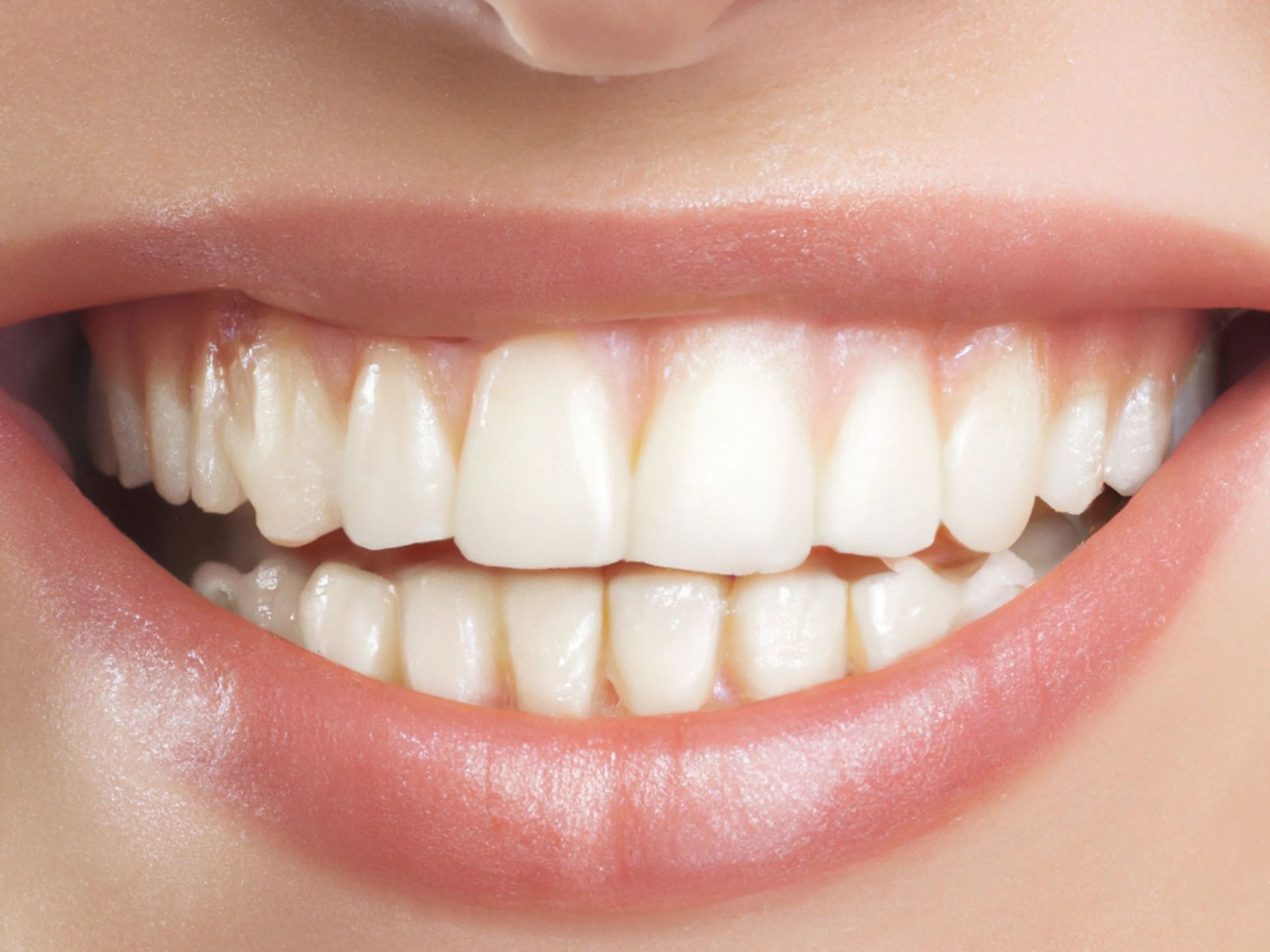 Clareamento Dental — Odontubel