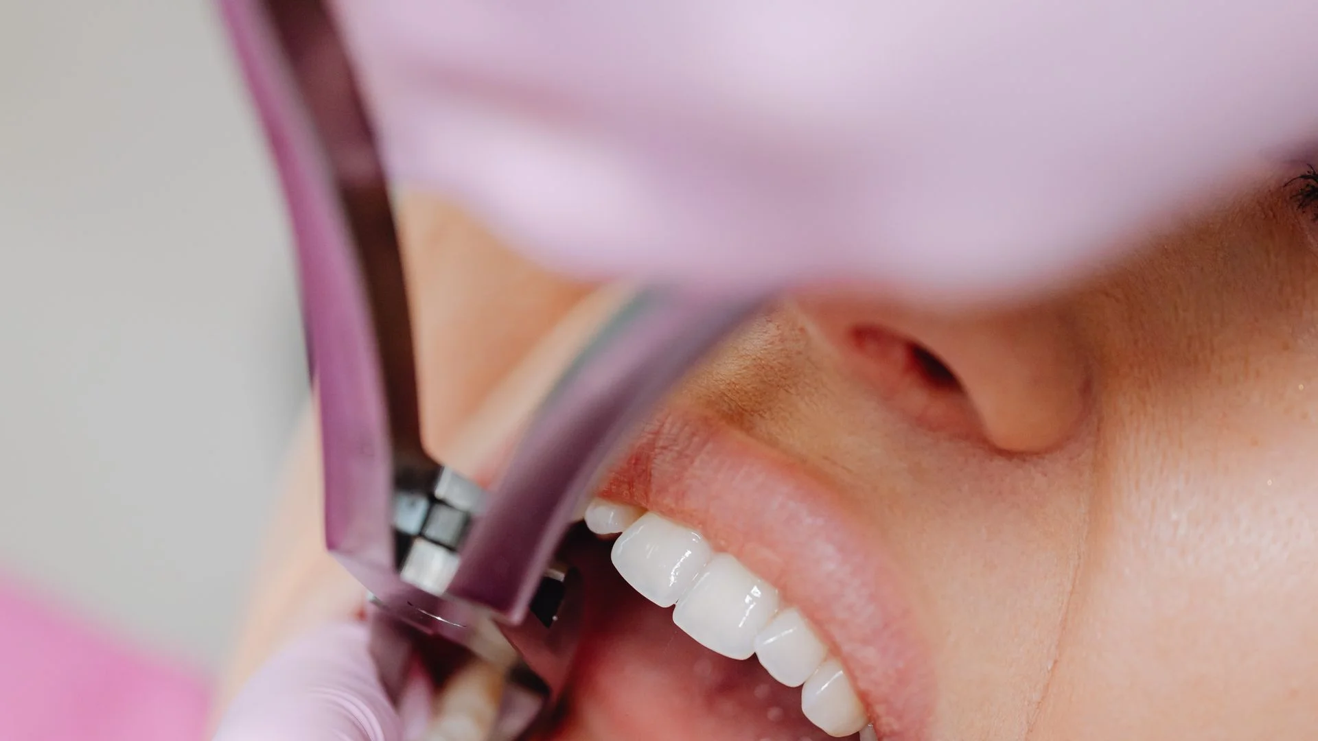 Extração Dentária — Odontubel